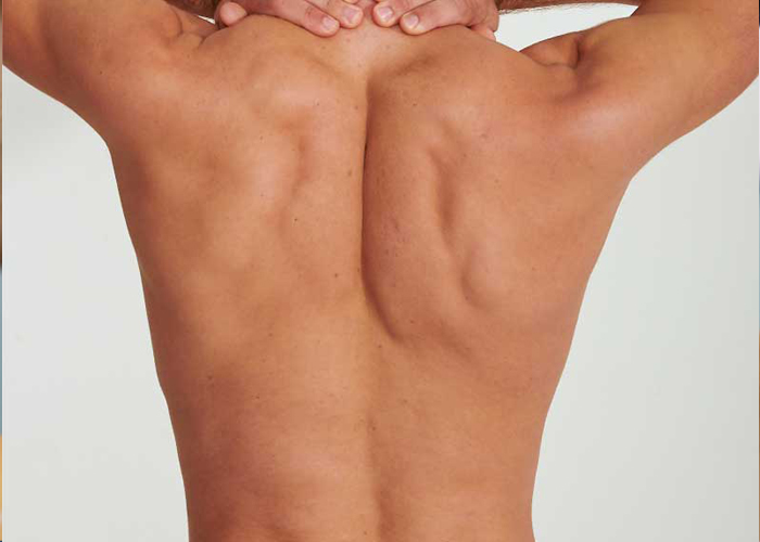 Full back & shoulders Laser Treatment