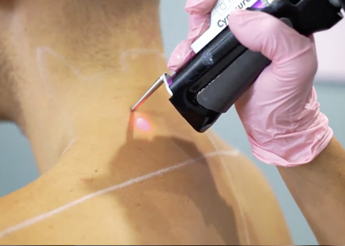 Shoulders Laser Treatment
