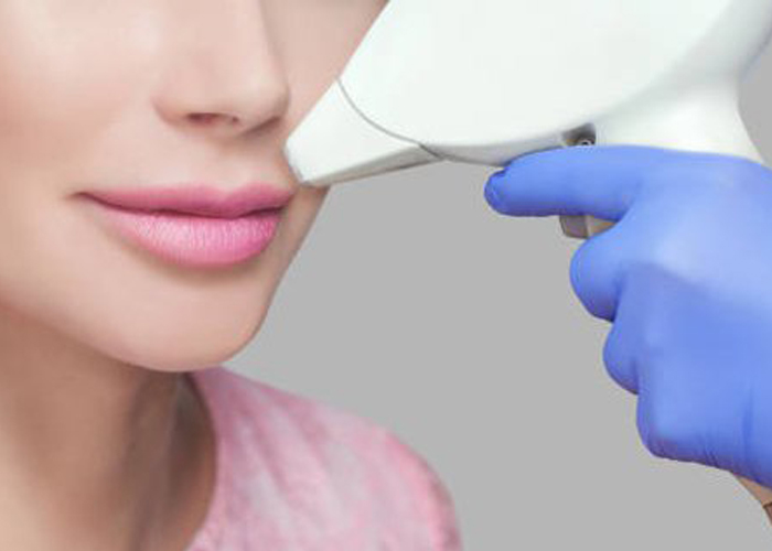 Upper Lip Laser Treatment